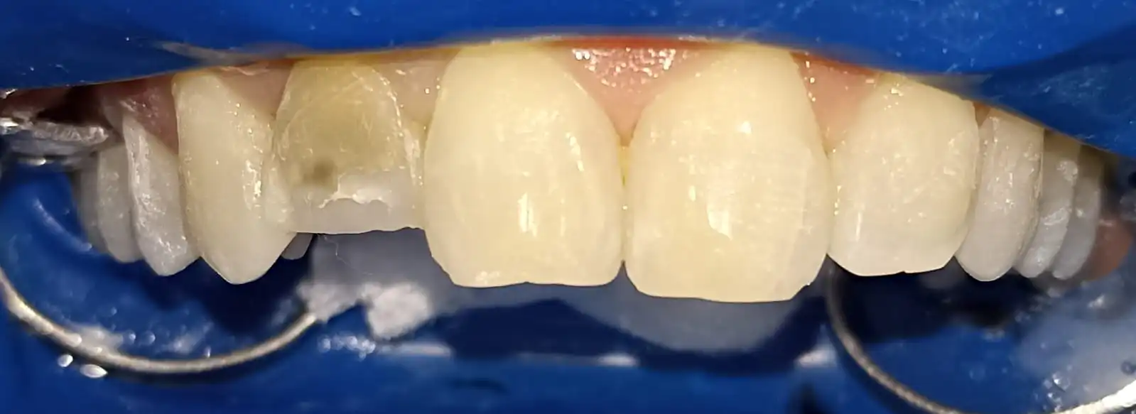 Antes del diseño de sonrisa con manchas